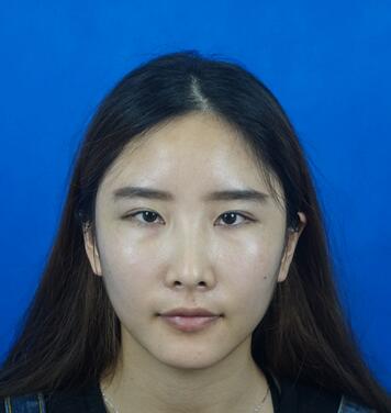 愛悅麗格膠原蛋白豐蘋果肌分享