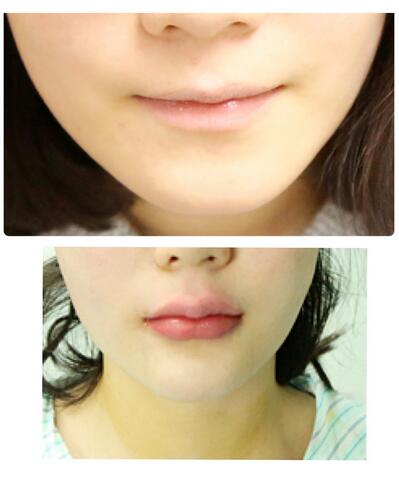 武漢中愛自體脂肪豐唇+面部填充恢復(fù)記錄