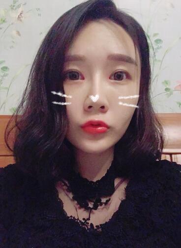 武漢中愛自體脂肪豐唇+面部填充恢復(fù)記錄