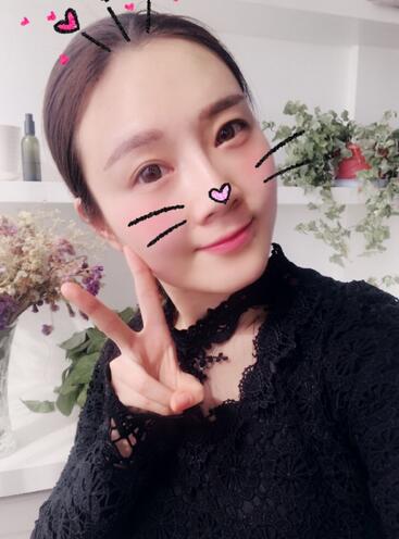 武漢中愛自體脂肪豐唇+面部填充恢復(fù)記錄