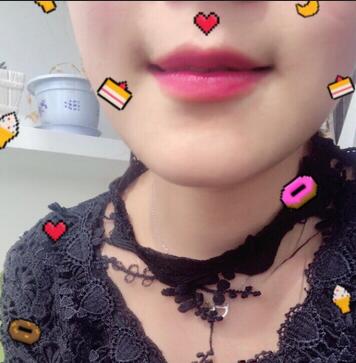 武漢中愛自體脂肪豐唇+面部填充恢復(fù)記錄