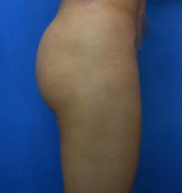 自體脂肪豐臀經(jīng)歷分享