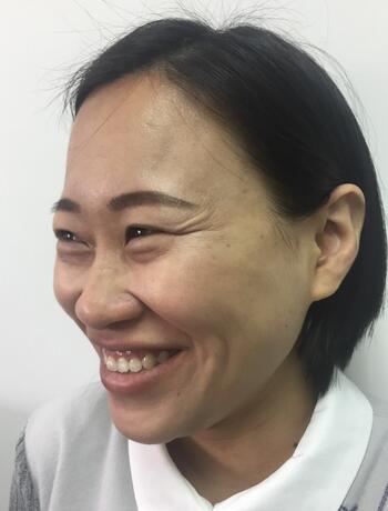 武漢中愛注射瘦臉去魚尾紋一個月