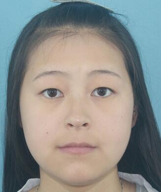 梨花雨割雙眼皮恢復半年了