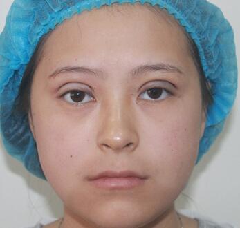 梨花雨割雙眼皮恢復半年了