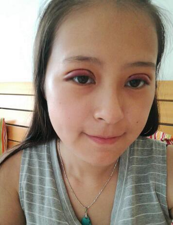 梨花雨割雙眼皮恢復半年了