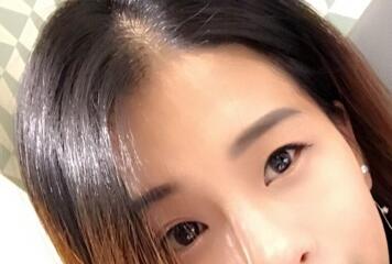 上海韓鏡割雙眼皮一個月