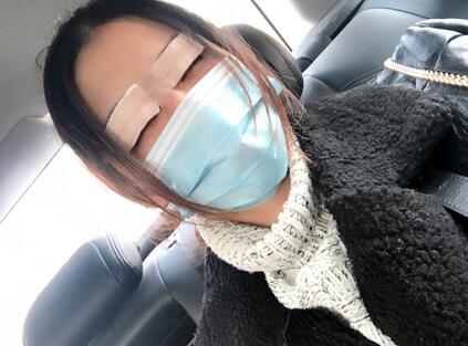 上海韓鏡割雙眼皮一個月