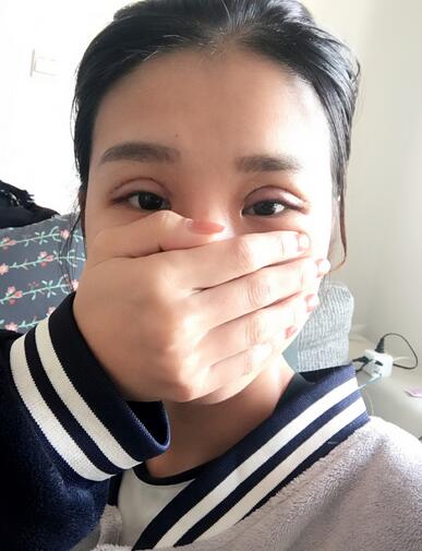 上海韓鏡割雙眼皮一個月