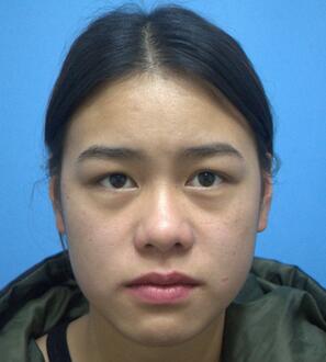 上海韓鏡網(wǎng)紅套餐半個月經(jīng)歷 雙眼皮多項整形+隆鼻整形+脂肪填充