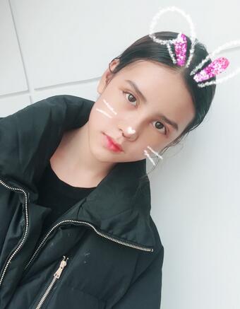 上海韓鏡網(wǎng)紅套餐半個月經(jīng)歷 雙眼皮多項整形+隆鼻整形+脂肪填充