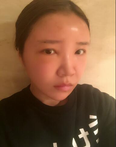 自體脂肪填充全臉1個月經歷