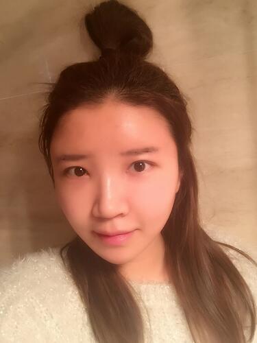 自體脂肪填充全臉1個月經歷