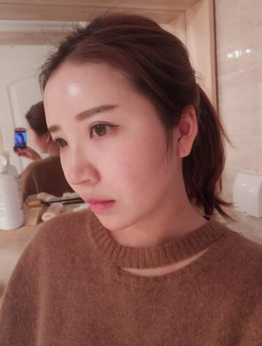 自體脂肪填充全臉1個月經歷