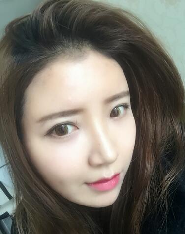 自體脂肪填充全臉1個月經歷