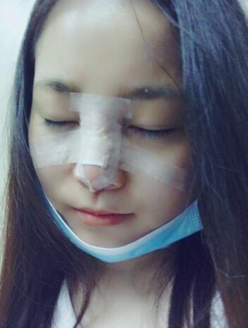 隆鼻整形日記 重慶鉑生硅膠隆鼻＋耳軟骨鼻尖
