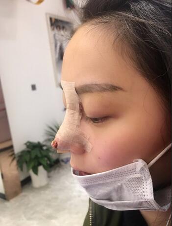 隆鼻修復術后恢復期經(jīng)歷