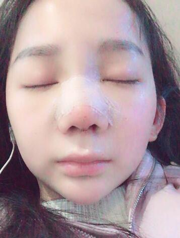 隆鼻修復術后恢復期經(jīng)歷