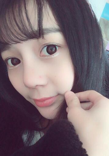 隆鼻修復術后恢復期經(jīng)歷