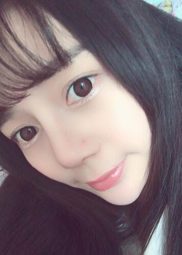 隆鼻修復術后恢復期經(jīng)歷