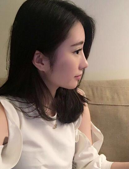 雙眼皮修復(fù)+自體脂肪填充恢復(fù)日記