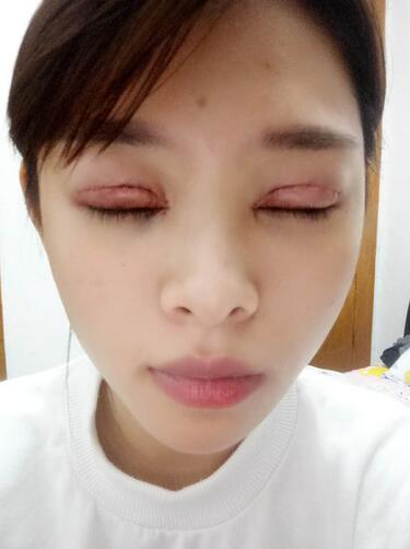 北京熙朵全切雙眼皮1個(gè)月恢復(fù)日記