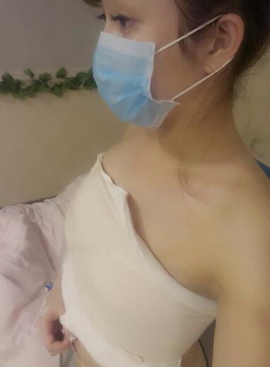 自體脂肪隆胸2個月經(jīng)歷