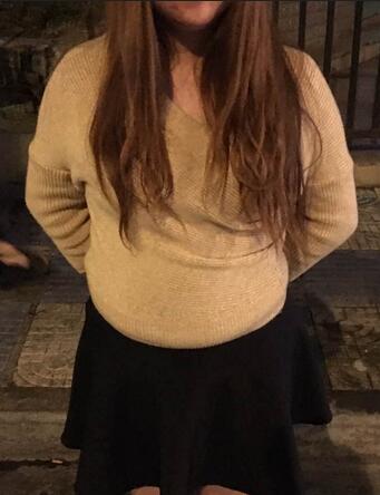 腰腹部吸脂后一個月照片