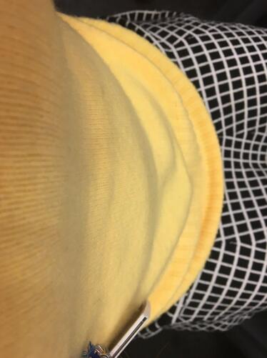 腰腹部吸脂后一個月照片