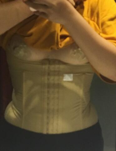 腰腹部吸脂后一個月照片