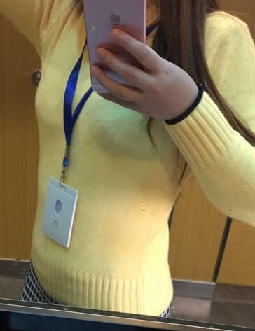 腰腹部吸脂后一個月照片