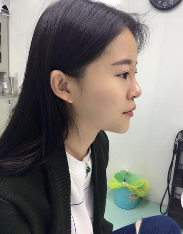 玻尿酸隆鼻恢復過程圖