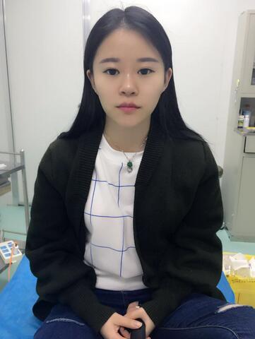 玻尿酸隆鼻恢復過程圖