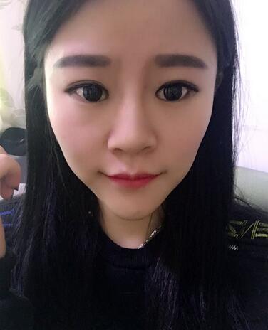 玻尿酸隆鼻恢復過程圖