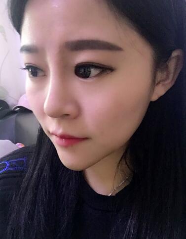 玻尿酸隆鼻恢復過程圖