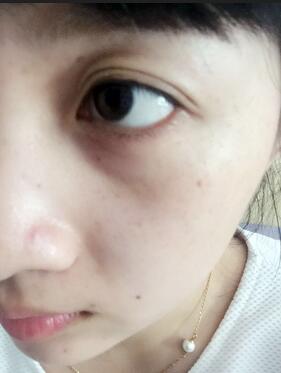 去魚尾紋的很好方法 注射瘦臉去魚尾紋果分享