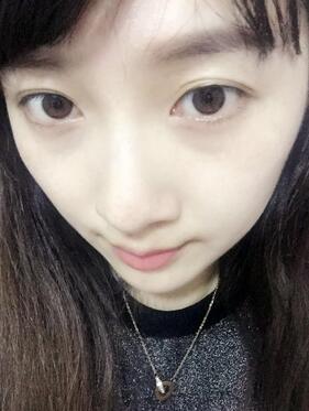 去魚尾紋的很好方法 注射瘦臉去魚尾紋果分享