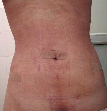 腰腹抽脂3個(gè)月的感受