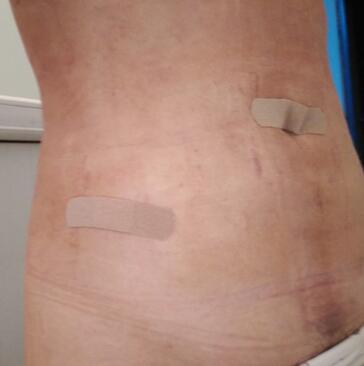 腰腹抽脂3個(gè)月的感受