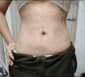 腰腹抽脂3個(gè)月的感受