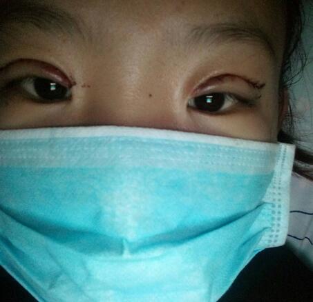 割雙眼皮術(shù)后恢復(fù)過(guò)程 全切雙眼皮3個(gè)月