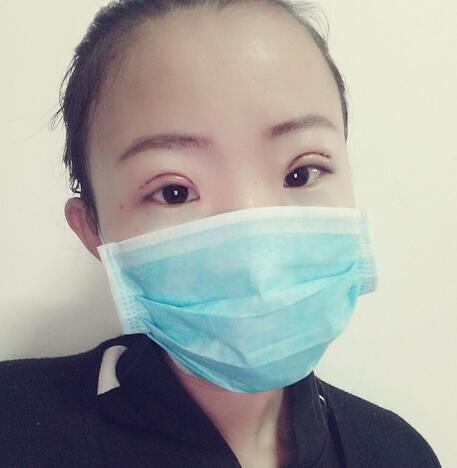 割雙眼皮術(shù)后恢復(fù)過(guò)程 全切雙眼皮3個(gè)月