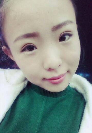 割雙眼皮術(shù)后恢復(fù)過(guò)程 全切雙眼皮3個(gè)月