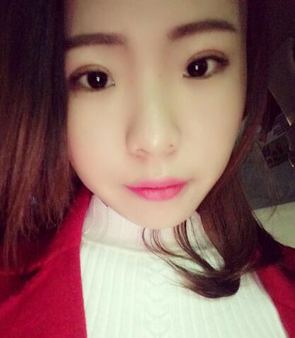 割雙眼皮術(shù)后恢復(fù)過(guò)程 全切雙眼皮3個(gè)月