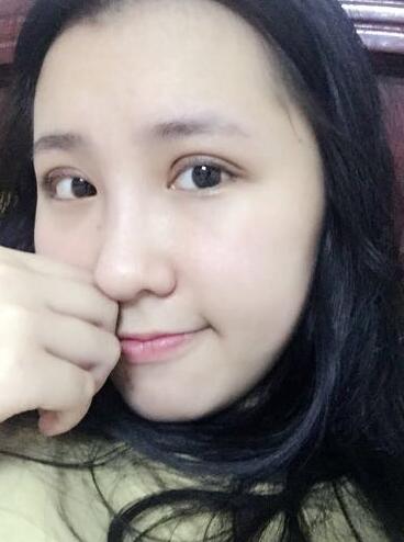 切的雙眼皮90天恢復(fù)過(guò)程圖