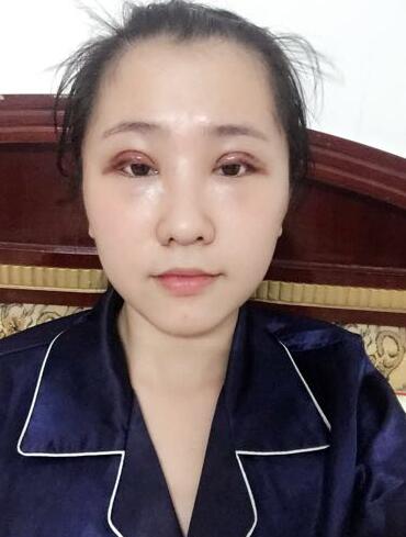 切的雙眼皮90天恢復(fù)過(guò)程圖