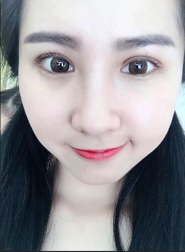 切的雙眼皮90天恢復(fù)過(guò)程圖