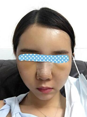 自體脂肪填充后2個(gè)月圖