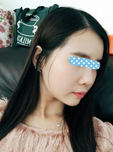 自體脂肪填充后2個(gè)月圖