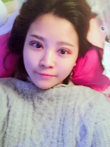 雙眼皮+開眼角3個月恢復過程圖